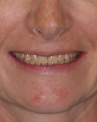 Full Mouth Reconstruction Case 6 - Before