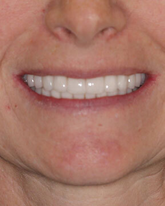 Full Mouth Reconstruction Case 6 - After