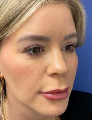 Eyelid Surgery (Blepharoplasty) Case 6 - After