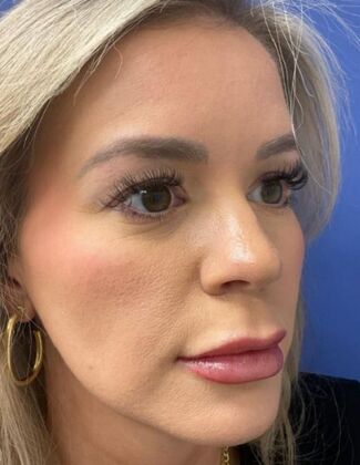 Eyelid Surgery (Blepharoplasty) Case 6 - Before