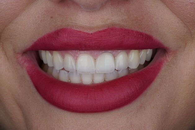 Before and After: Case 17 - After