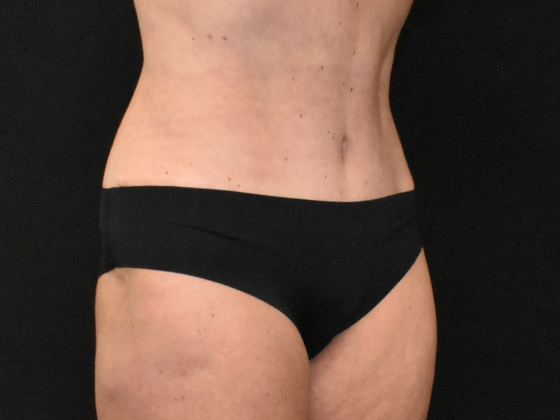 Abdominoplasty: Case 38 - After