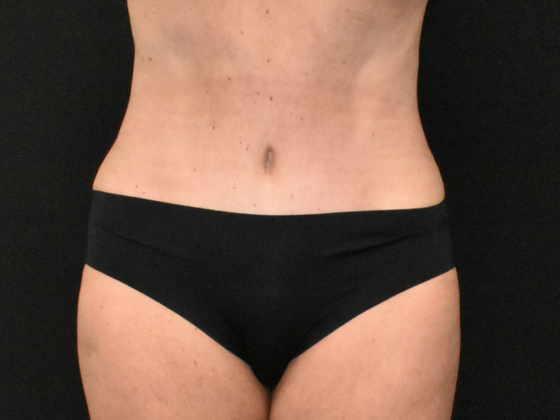 Abdominoplasty: Case 38 - After