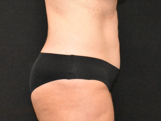 Abdominoplasty: Case 38 - Before