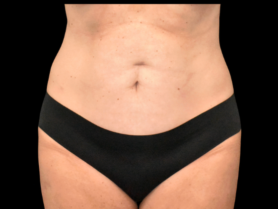 Abdominoplasty: Case 38 - Before