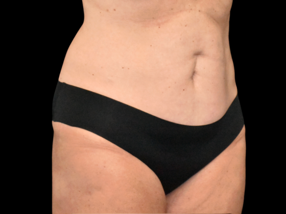 Abdominoplasty: Case 38 - Before