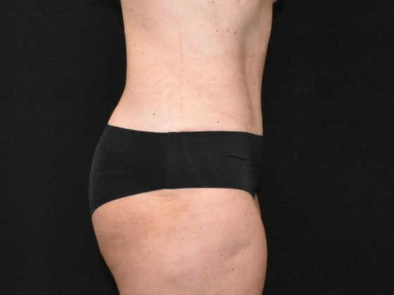Abdominoplasty: Case 38 - After