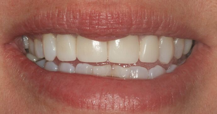 Before & After | Crowns Cases