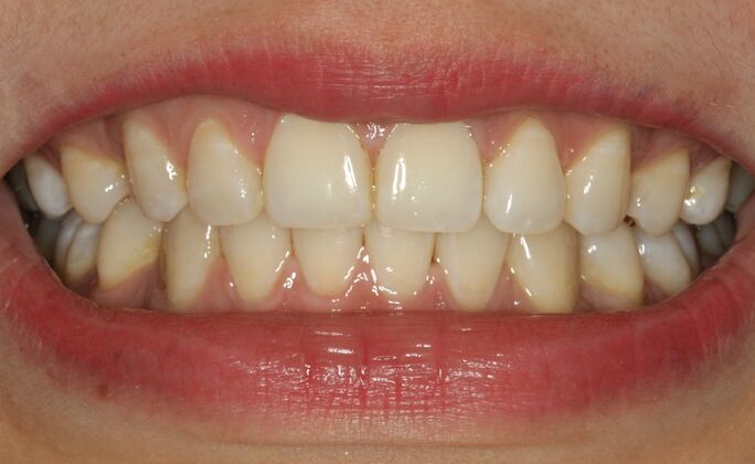 Before & After | Orthodontics Cases