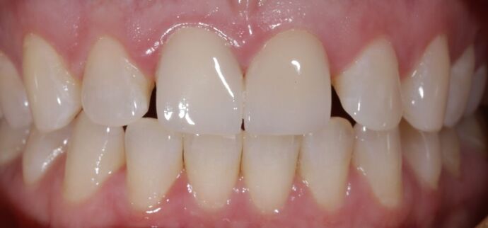 Before & After | Crowns Case 1 - Before