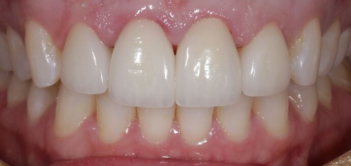 Before & After | Crowns Case 1 - After