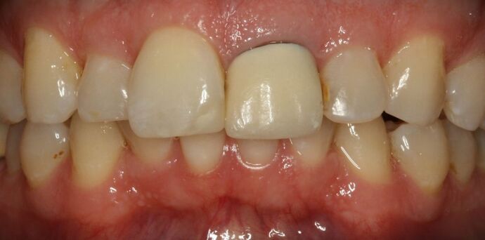Before & After | Crowns Case 2 - Before