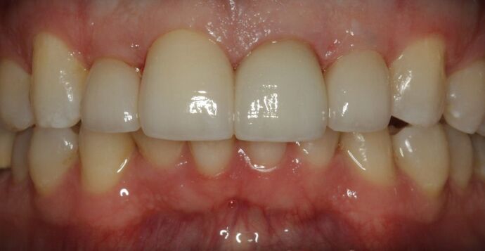Before & After | Crowns Case 2 - After