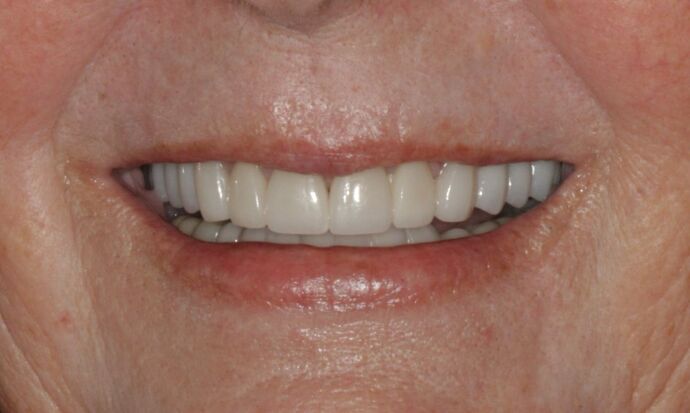 Before & After | Crowns Case 3 - After