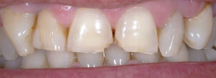 Before & After | Crowns Case 4 - Before