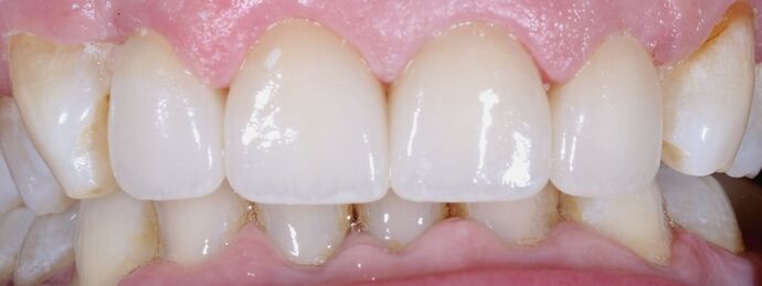 Before & After | Crowns Case 4 - After