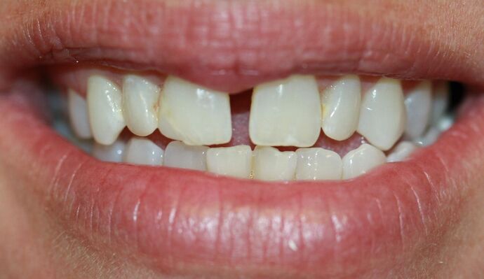 Before & After | Crowns Case 5 - Before