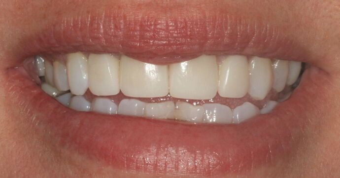 Before & After | Crowns Case 5 - After