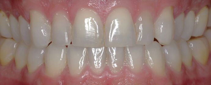 Before & After | Orthodontics Case 1 - After