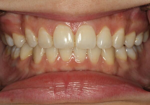 Before & After | Orthodontics: Case 2 - After