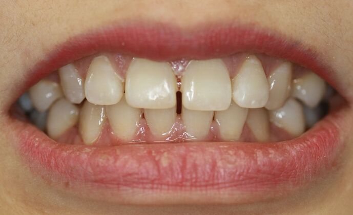 Before & After | Orthodontics Case 2 - Before