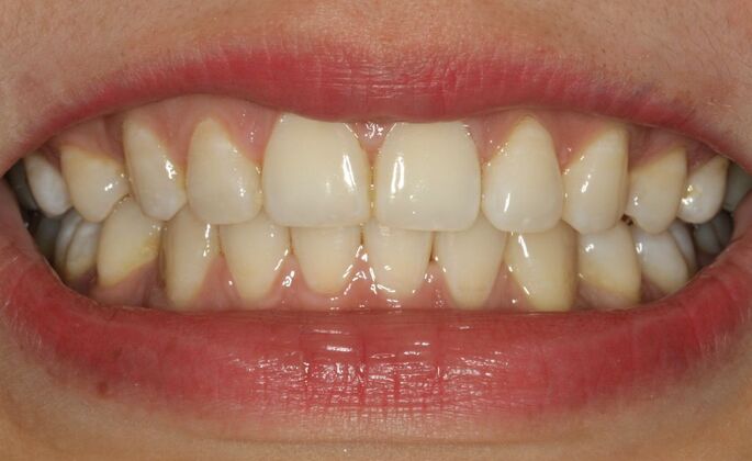 Before & After | Orthodontics Case 2 - After