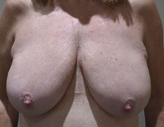Breast Reduction: Case 215 - Before