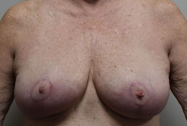 Breast Reduction: Case 215 - After