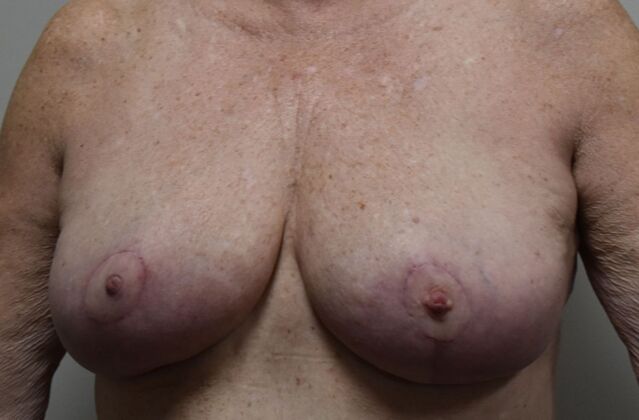 Breast Reduction: Case 215 - After