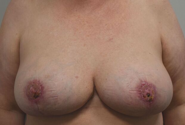 Breast Implant Removal Case 68 - After