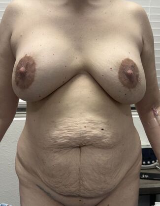 Mommy Makeover Case 375 - Before