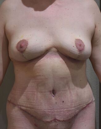 Mommy Makeover Case 375 - After