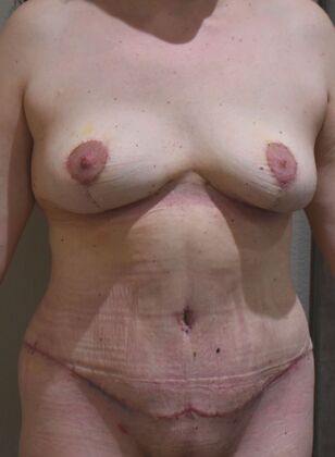 Mommy Makeover: Case 375 - After