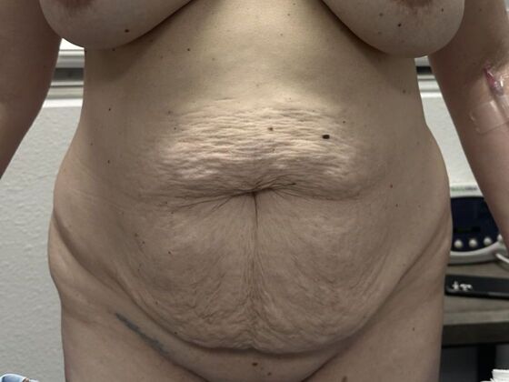 Tummy Tuck (Abdominoplasty): Case 586 - Before
