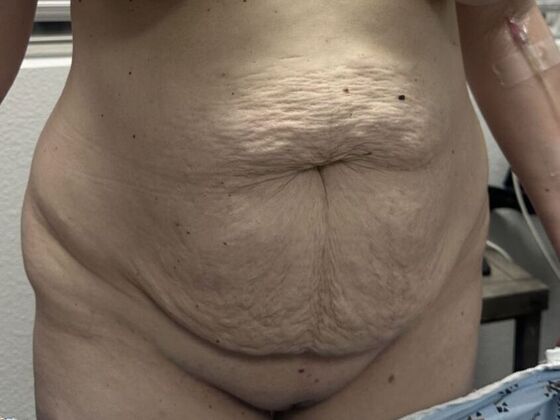 Tummy Tuck (Abdominoplasty): Case 586 - Before