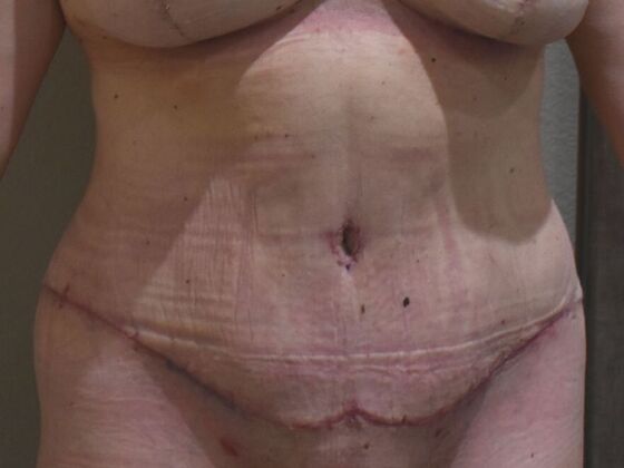 Tummy Tuck (Abdominoplasty): Case 586 - After