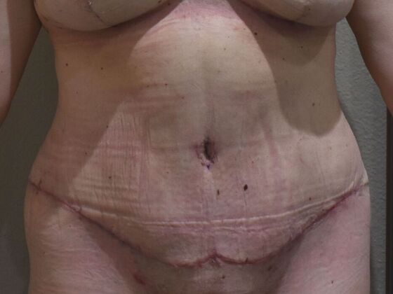 Tummy Tuck (Abdominoplasty): Case 586 - After