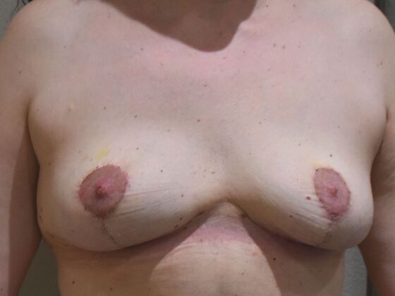 Breast Revision: Case 337 - After