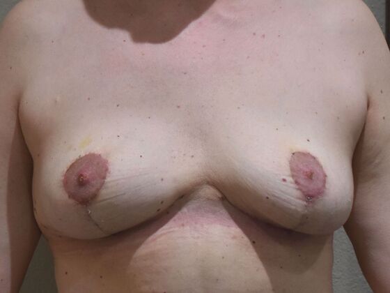 Breast Implant Removal Case 69 - After
