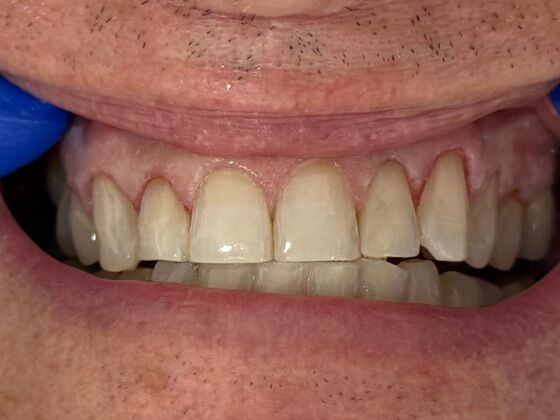 Tooth-colored Fillings Case 1 - After