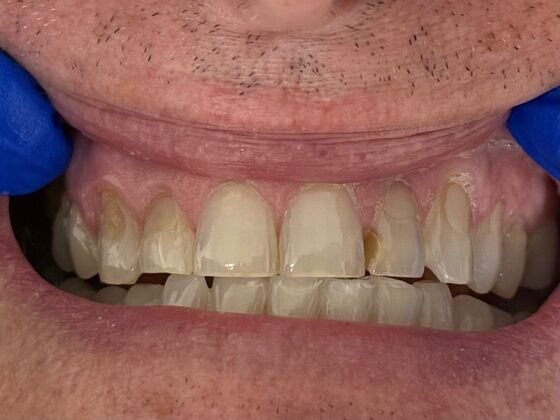 Tooth-colored Fillings Case 1 - Before