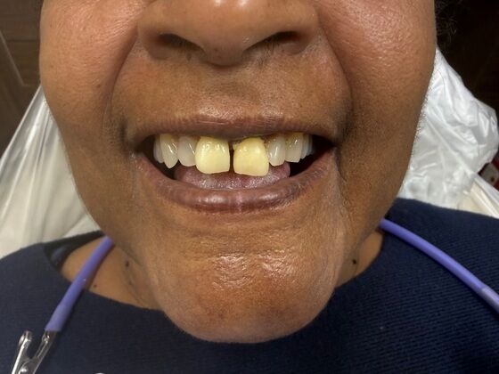Anterior Crowns Case 1 - Before