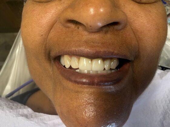 Anterior Crowns Case 1 - After