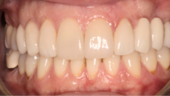 Bridges Case 1 - After