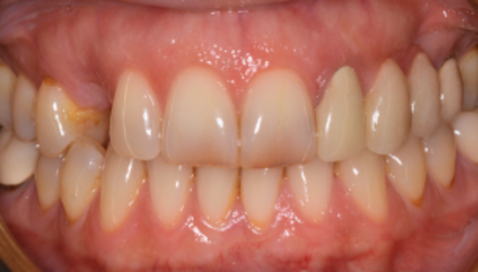 Bridges Case 1 - Before