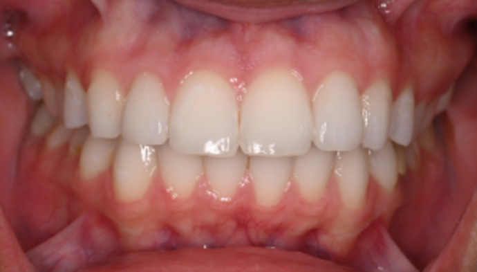 Veneers Case 9 - After