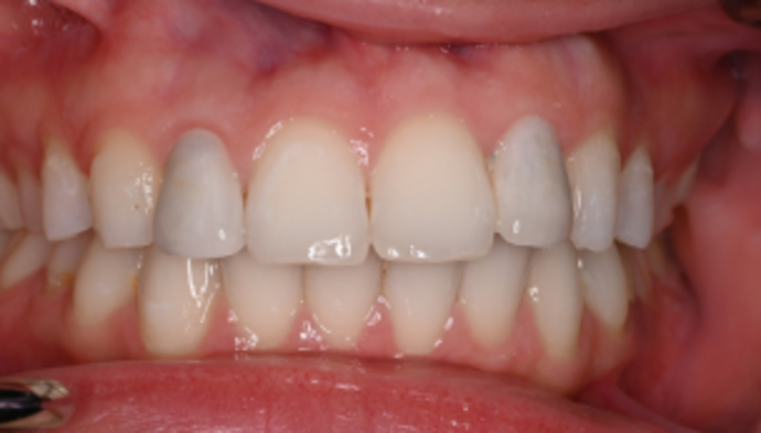 Veneers Case 9 - Before