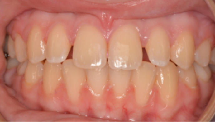 Veneers Case 10 - Before