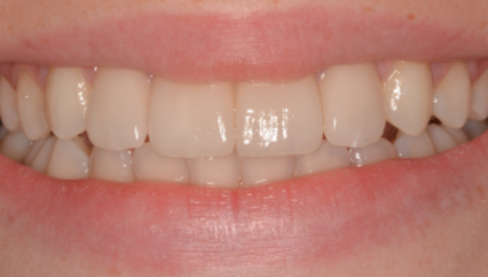 Veneers Case 10 - After