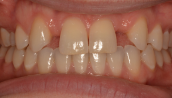 Dental Implants Case 1 - Before